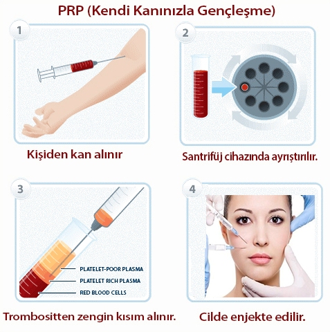 prp platelletten zengin plazma