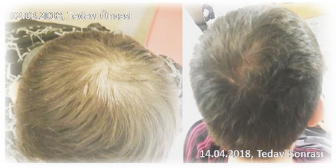 saç mezoterapisi alopezi kellik dökülme