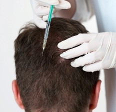 saç mezoterapisi alopezi kellik dökülme