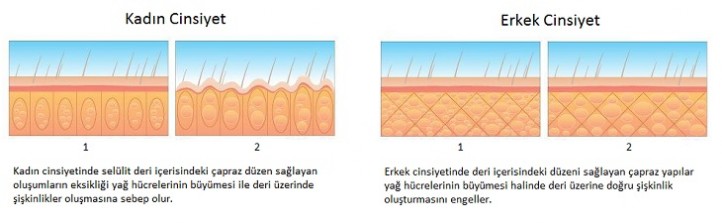 bölgesel yağlanma lipoliz selülit